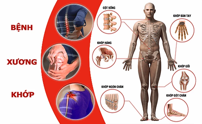 8 căn bệnh xương khớp thường gặp và cách phòng tránhBệnh viện Đa khoa Hợp Lực